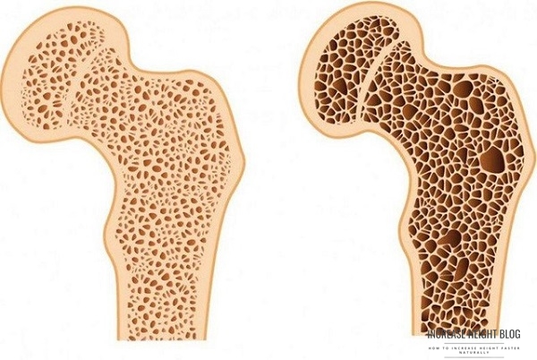 Osteoporosis is increasingly affecting younger individuals