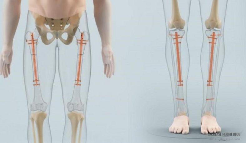 Is Leg-Lengthening Surgery Worth Considering?